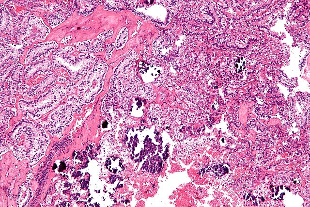 CARCINOMA RENAL DEL CONDUCTO COLECTOR - Binipatia e higienismo