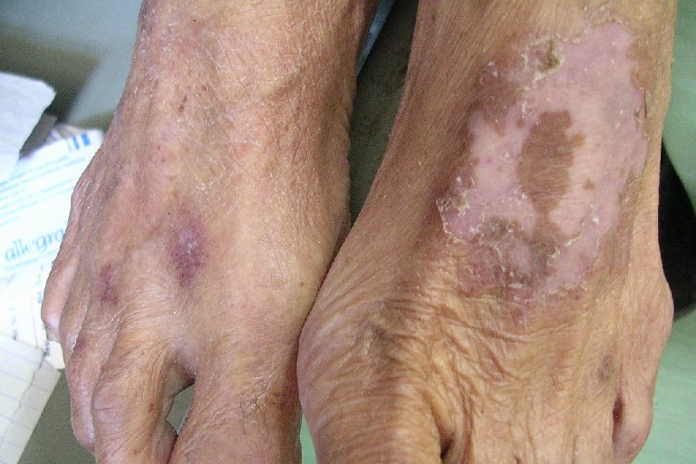 ACROQUERATOSIS DE BASEX - Binipatia e higienismo